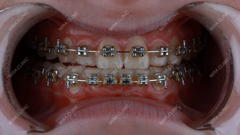 Tooth alignment